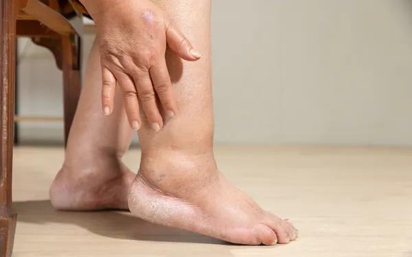 Leg Swelling Doctor Mesa AZ