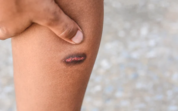 Non-healing Wounds Doctor Mesa AZ