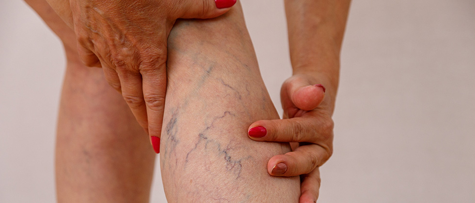 PAD vs Varicose Veins